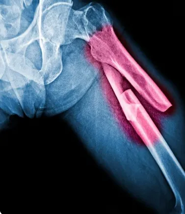 Femur fracture diagnosis, treatment, and surgical care